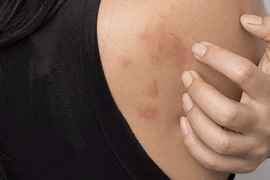 Allergy Symptoms Skin rashes